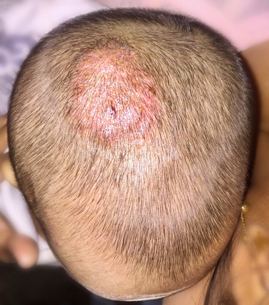 tinea capitis Archives - The Dermatology Digest